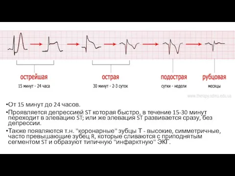 От 15 минут до 24 часов. Проявляется депрессией ST которая быстро, в