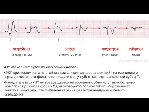 От нескольких суток до нескольких недель ЭКГ-критерием начала этой стадии считается возвращение