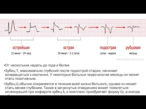 От нескольких недель до года и более Зубец Т, максимально глубокий после