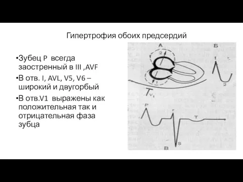 Гипертрофия обоих предсердий Зубец P всегда заостренный в III ,AVF В отв.