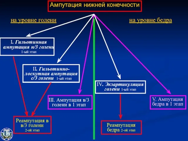 Ампутация нижней конечности I. Гильотинная ампутация н/3 голени 1-ый этап II. Гильотинно-