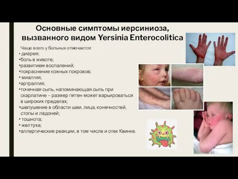 Основные симптомы иерсиниоза, вызванного видом Yersinia Enterocolitica Чаще всего у больных отмечается: