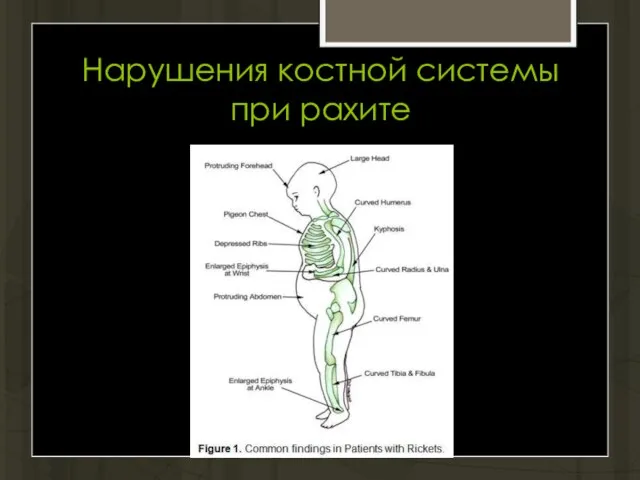 Нарушения костной системы при рахите