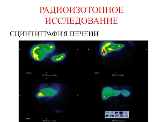 РАДИОИЗОТОПНОЕ ИССЛЕДОВАНИЕ СЦИНТИГРАФИЯ ПЕЧЕНИ