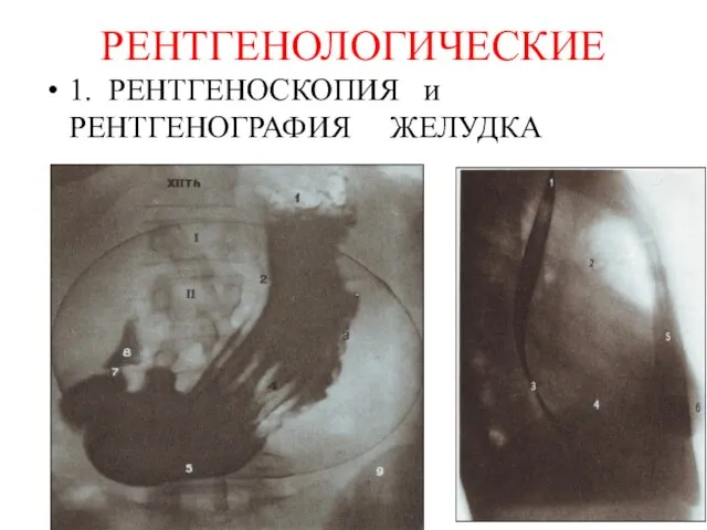 РЕНТГЕНОЛОГИЧЕСКИЕ 1. РЕНТГЕНОСКОПИЯ и РЕНТГЕНОГРАФИЯ ЖЕЛУДКА