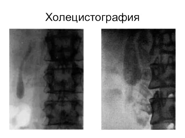 Холецистография