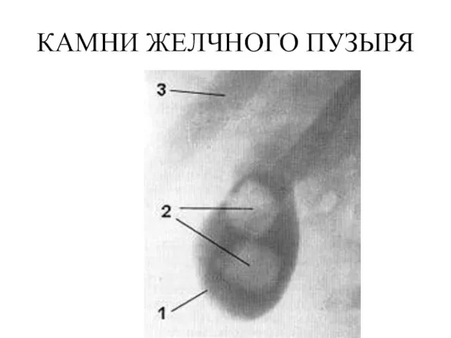 КАМНИ ЖЕЛЧНОГО ПУЗЫРЯ