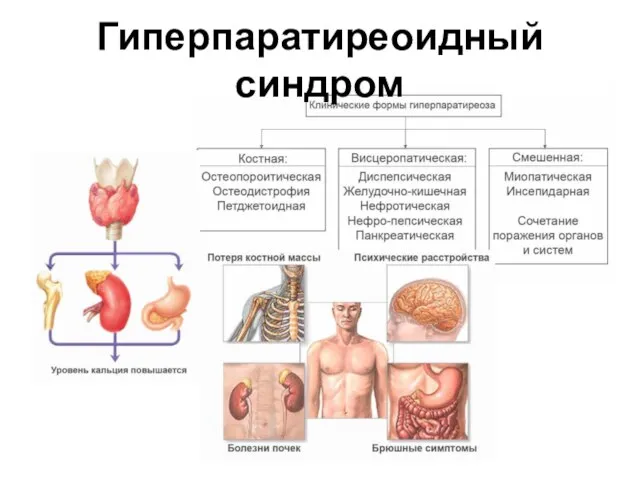 Гиперпаратиреоидный синдром