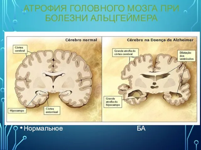 АТРОФИЯ ГОЛОВНОГО МОЗГА ПРИ БОЛЕЗНИ АЛЬЦГЕЙМЕРА Нормальное БА