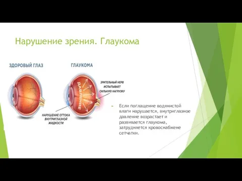 Нарушение зрения. Глаукома Если поглащение водянистой влаги нарушается, внутриглазное давление возрастает и