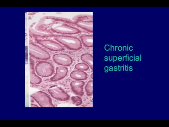 Chronic superficial gastritis