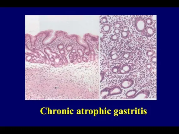 Chronic atrophic gastritis