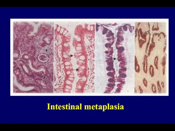 Intestinal metaplasia