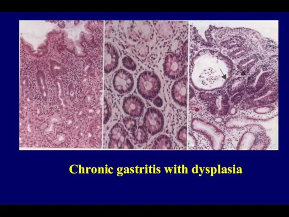 Chronic gastritis with dysplasia