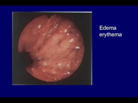 Edema erythema