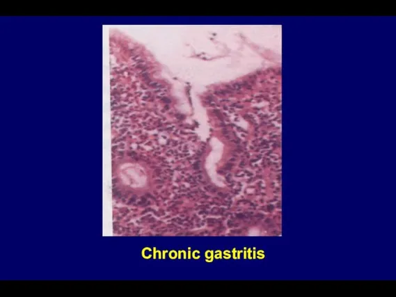 Chronic gastritis