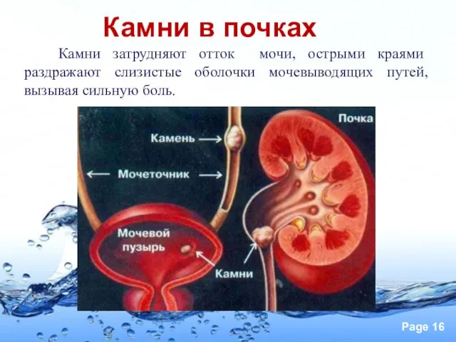 Камни в почках Камни затрудняют отток мочи, острыми краями раздражают слизистые оболочки