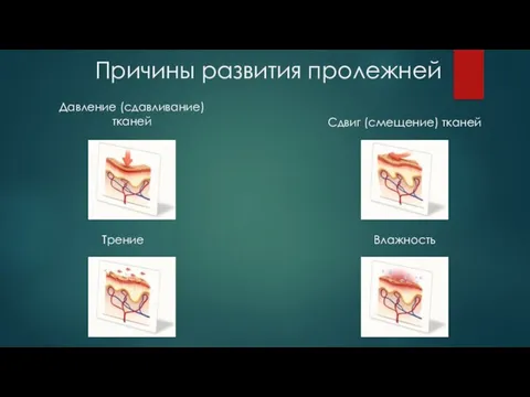 Причины развития пролежней Давление (сдавливание) тканей Сдвиг (смещение) тканей Трение Влажность