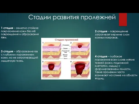 Стадии развития пролежней 1 стадия – заметно стойкое покраснение кожи без её