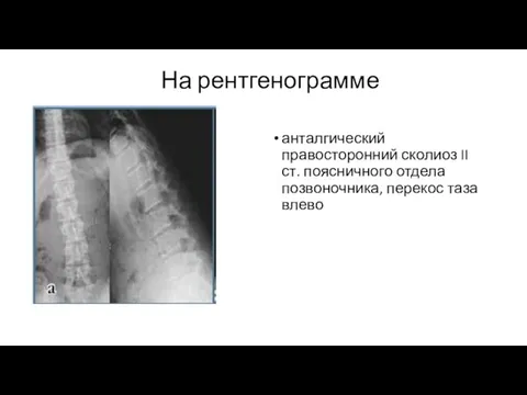 На рентгенограмме анталгический правосторонний сколиоз II ст. поясничного отдела позвоночника, перекос таза влево