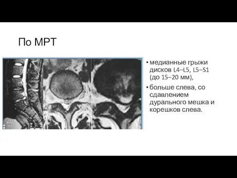 По МРТ медианные грыжи дисков L4–L5, L5–S1 (до 15–20 мм), больше слева,