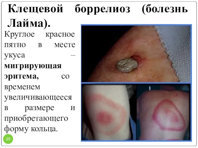 Клещевой боррелиоз (болезнь Лайма). Круглое красное пятно в месте укуса – мигрирующая