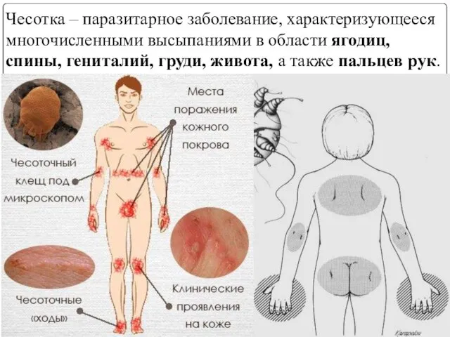 Чесотка – паразитарное заболевание, характеризующееся многочисленными высыпаниями в области ягодиц, спины, гениталий,