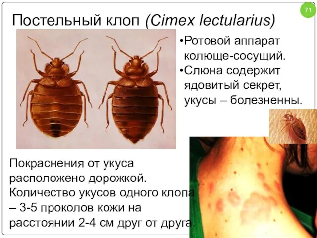 Постельный клоп (Cimex lectularius) Покраснения от укуса расположено дорожкой. Количество укусов одного