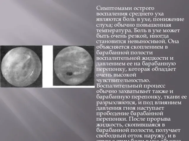 Симптомами острого воспаления среднего уха являются боль в ухе, понижение слуха; обычно