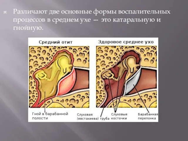 Различают две основные формы воспалительных процессов в среднем ухе — это катаральную и гнойную.