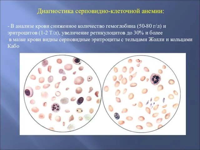 Диагностика серповидно-клеточной анемии: - В анализе крови сниженное количество гемоглобина (50-80 г/л)