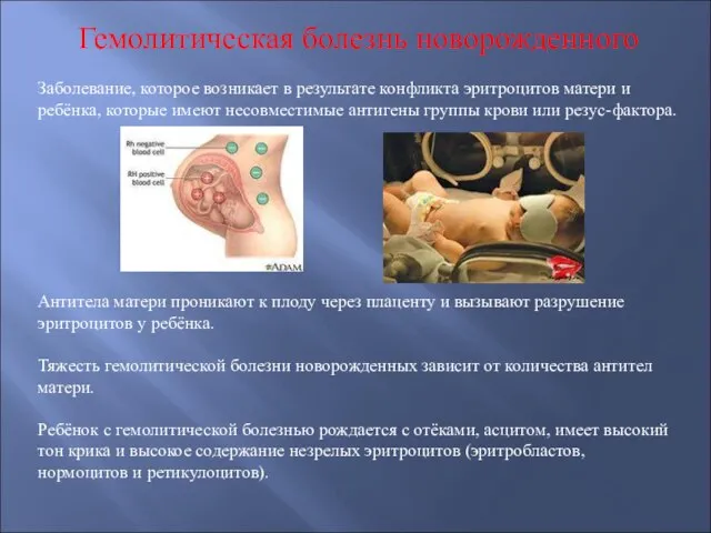 Гемолитическая болезнь новорожденного Заболевание, которое возникает в результате конфликта эритроцитов матери и