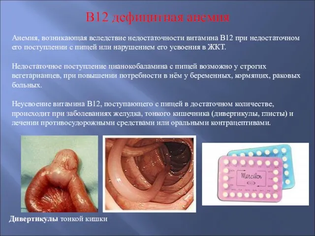 В12 дефицитная анемия Анемия, возникающая вследствие недостаточности витамина В12 при недостаточном его