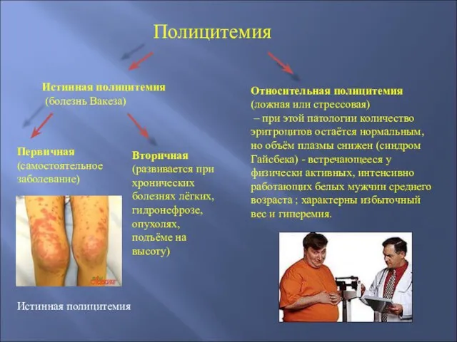 Полицитемия Истинная полицитемия (болезнь Вакеза) Первичная (самостоятельное заболевание) Вторичная (развивается при хронических