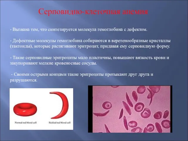 Серповидно-клеточная анемия - Вызвана тем, что синтезируется молекула гемоглобина с дефектом. -