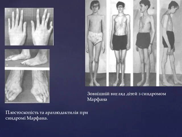 Зовнішній вигляд дітей з синдромом Марфана Плостоскопість та арахнодактилія при синдромі Марфана.