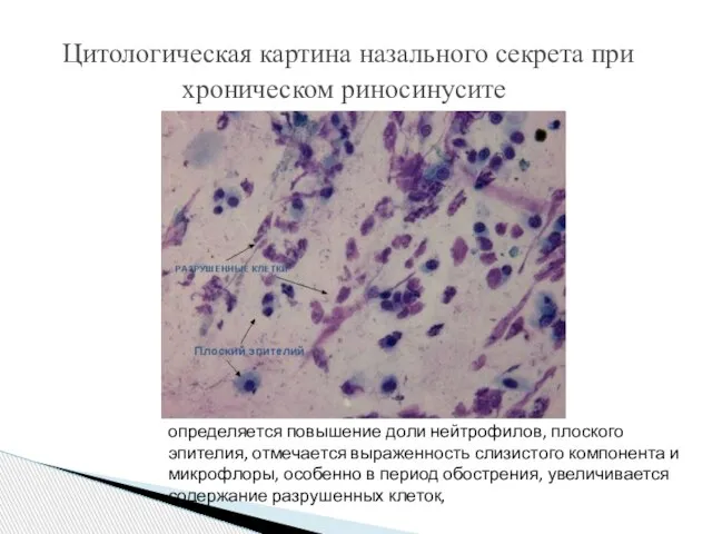 Цитологическая картина назального секрета при хроническом риносинусите определяется повышение доли нейтрофилов, плоского