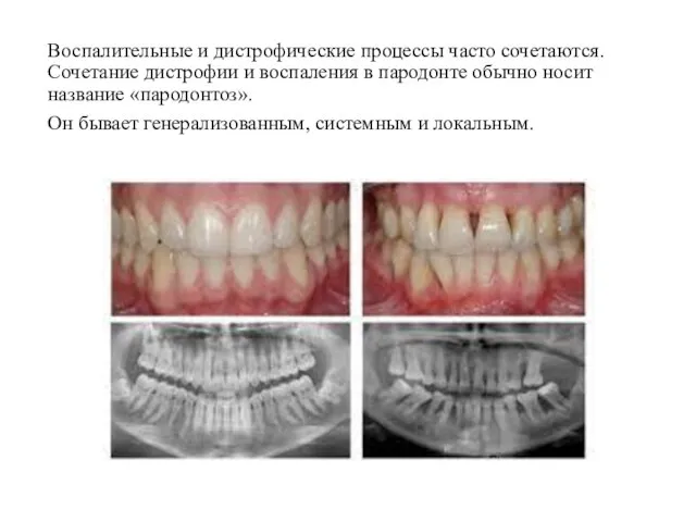 Воспалительные и дистрофические процессы часто сочетаются. Сочетание дистрофии и воспаления в пародонте