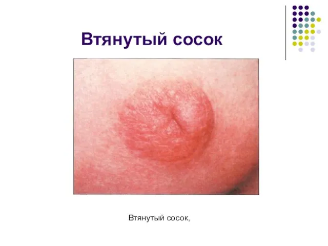 Втянутый сосок Втянутый сосок,