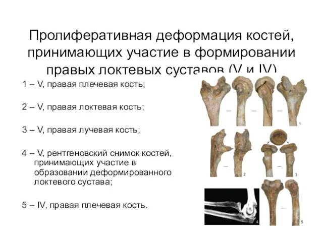 Пролиферативная деформация костей, принимающих участие в формировании правых локтевых суставов (V и