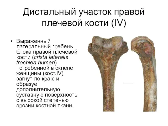 Дистальный участок правой плечевой кости (IV) Выраженный латеральный гребень блока правой плечевой