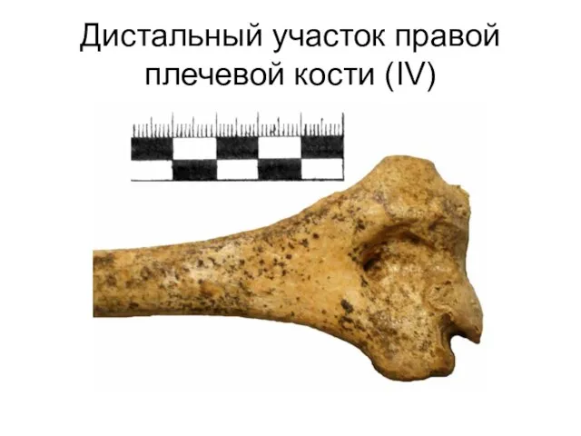 Дистальный участок правой плечевой кости (IV)