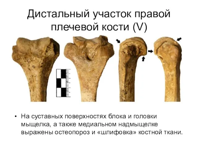 Дистальный участок правой плечевой кости (V) На суставных поверхностях блока и головки