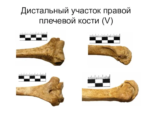 Дистальный участок правой плечевой кости (V)