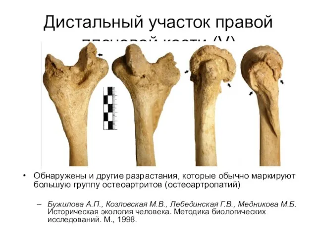 Дистальный участок правой плечевой кости (V) Обнаружены и другие разрастания, которые обычно