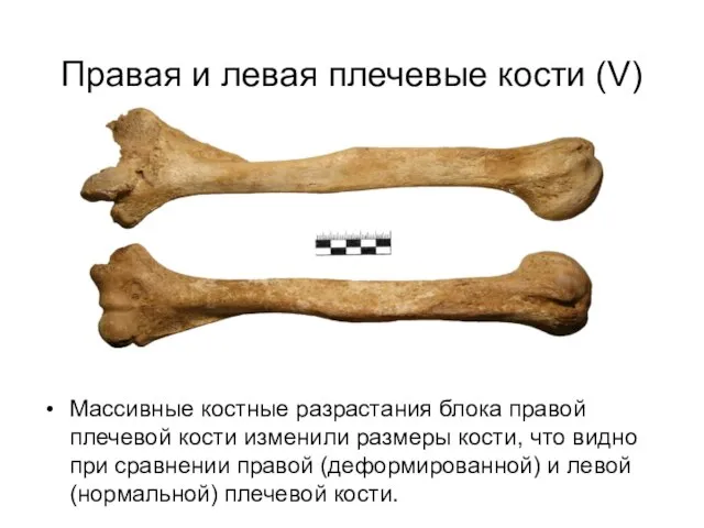 Правая и левая плечевые кости (V) Массивные костные разрастания блока правой плечевой