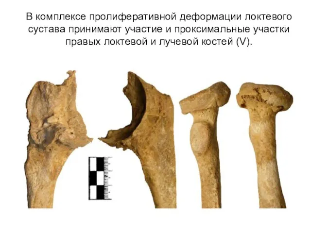 В комплексе пролиферативной деформации локтевого сустава принимают участие и проксимальные участки правых