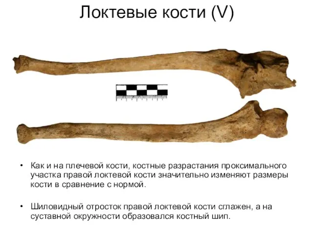 Локтевые кости (V) Как и на плечевой кости, костные разрастания проксимального участка