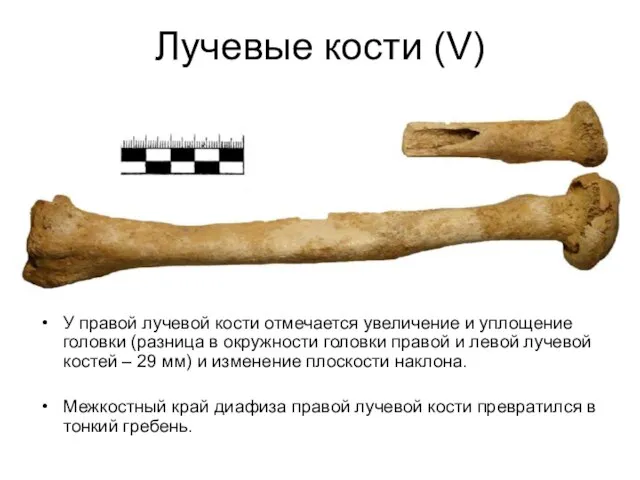 Лучевые кости (V) У правой лучевой кости отмечается увеличение и уплощение головки