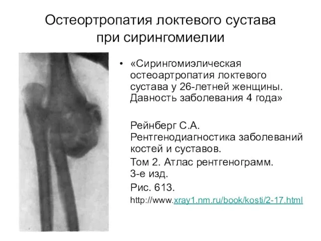 Остеортропатия локтевого сустава при сирингомиелии «Сирингомиэлическая остеоартропатия локтевого сустава у 26-летней женщины.